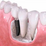 Que es un implante dental