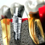 Ventajas del implante dental