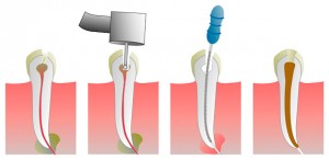 Endodoncia 4